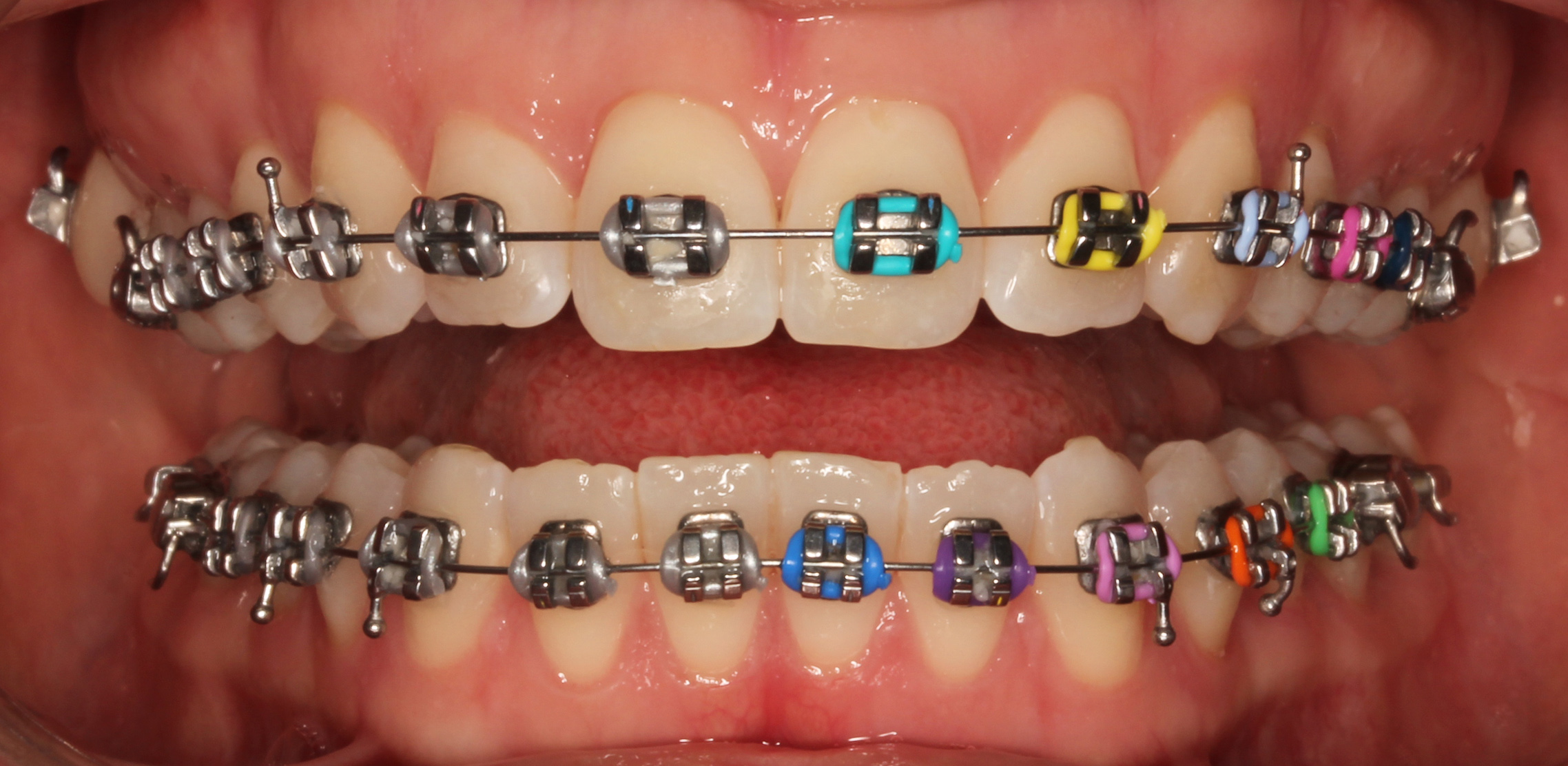 Orthodontics Australia  How are metal and ceramic braces different?
