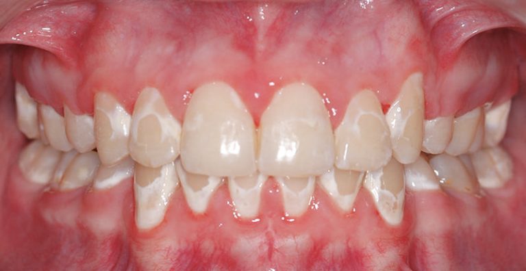 why-do-i-have-white-spots-on-my-teeth-peninsula-orthodontics